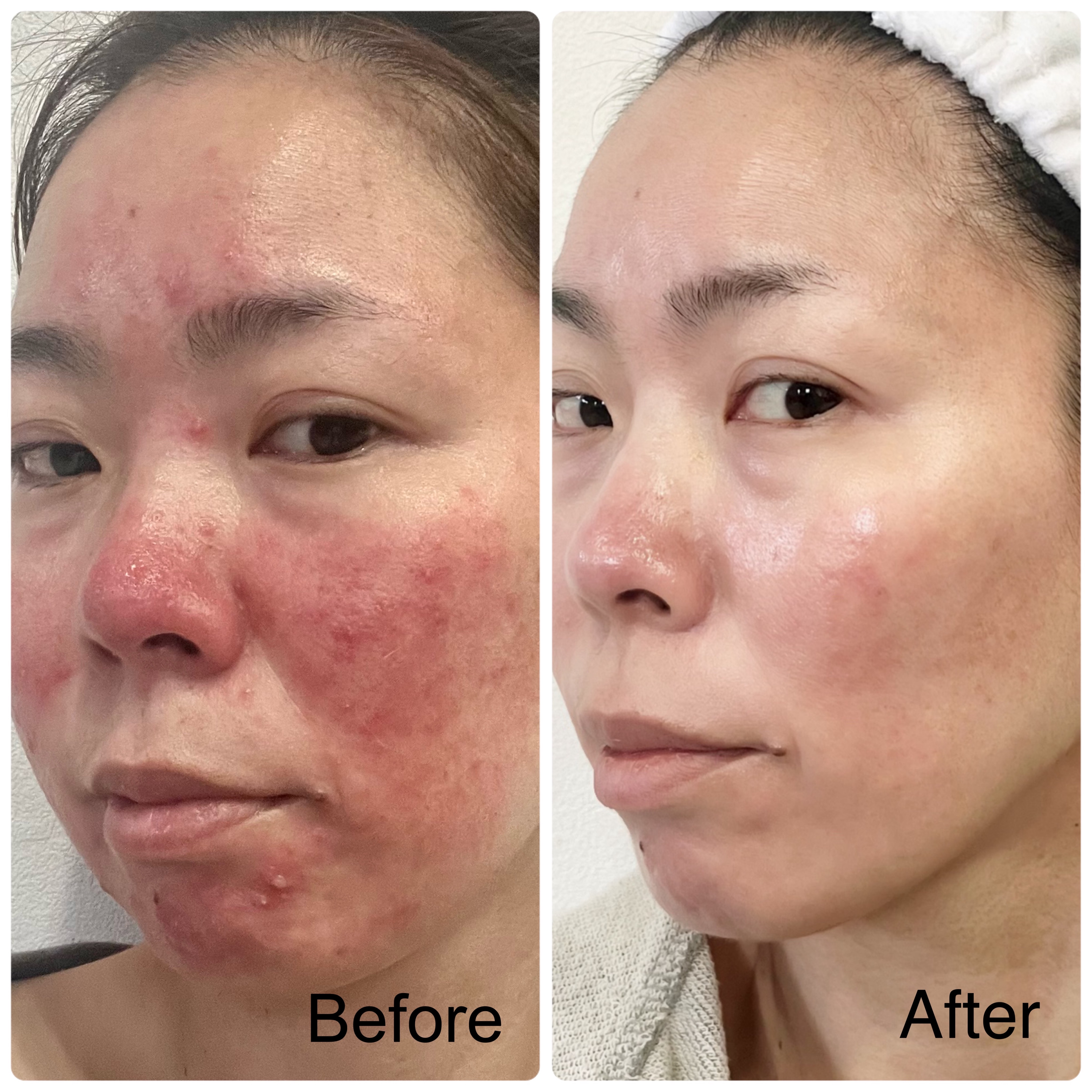 重度酒さだった私がノーファンデになるまで